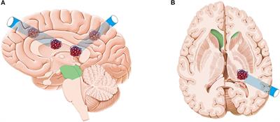 Endoscopic Surgery for Supratentorial Deep Cavernous Malformation Adjacent to Cortical Spinal Tract: Preliminary Experience and Technical Note